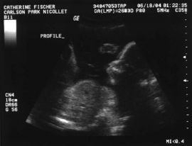18 Weeks Pregnant Ultrasound Pictures