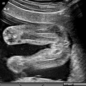 18 Weeks Pregnant Ultrasound Pictures